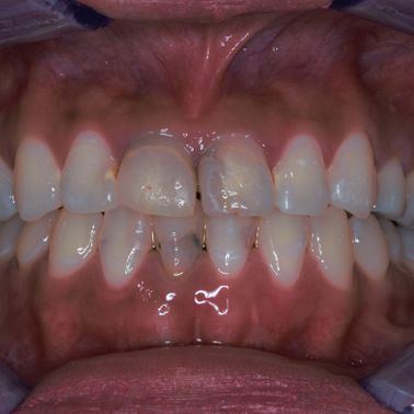 Customers teeth before treatment