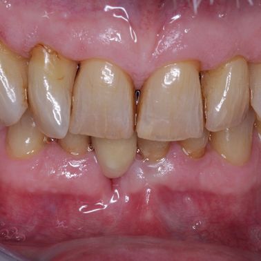 Customers teeth After treatment