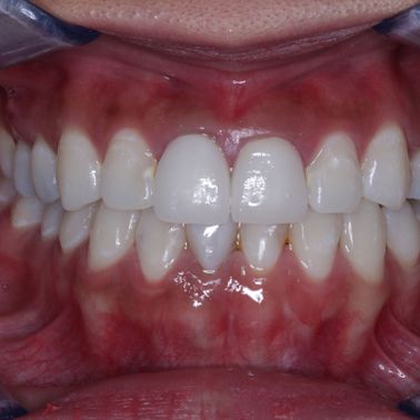 Customers teeth after treatment
